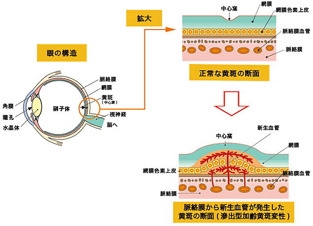 加齢黄斑変性｜国分寺さくら眼科